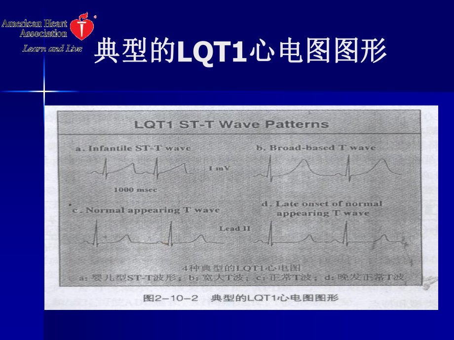 长Q-T间期综合征.ppt_第2页