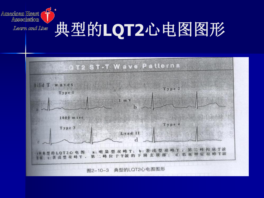 长Q-T间期综合征.ppt_第3页