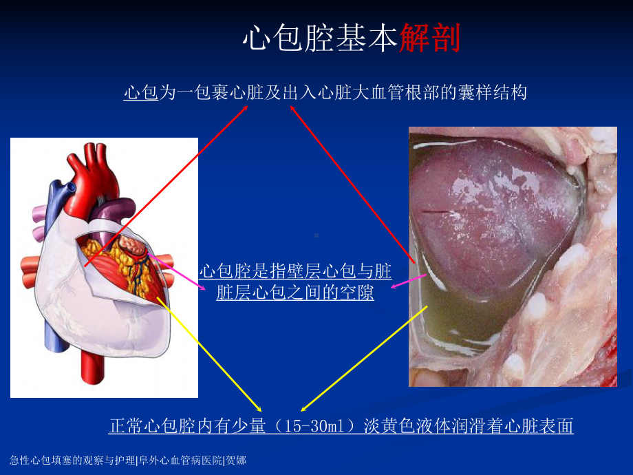 心包填塞正式版.ppt_第2页