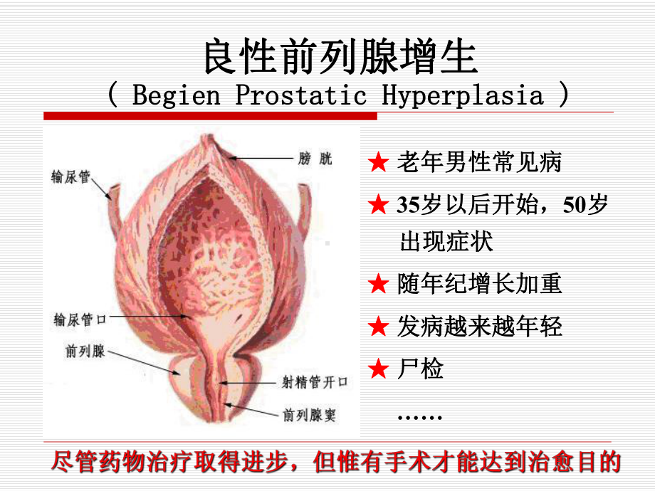 TURP-BPH手术“金标准”的再认识课件.ppt_第2页