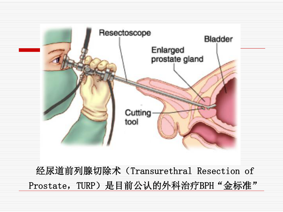 TURP-BPH手术“金标准”的再认识课件.ppt_第3页