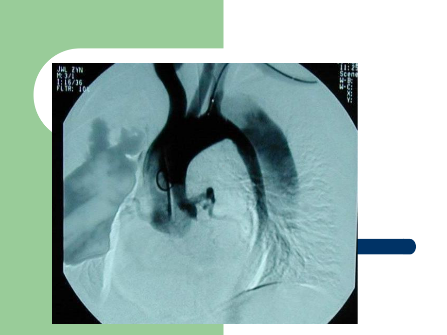 主动脉夹层(AD)临床诊断和治疗课件.ppt_第3页