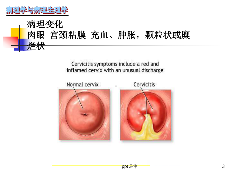 《病理与病理生理学》女性生殖系统-课件.ppt_第3页