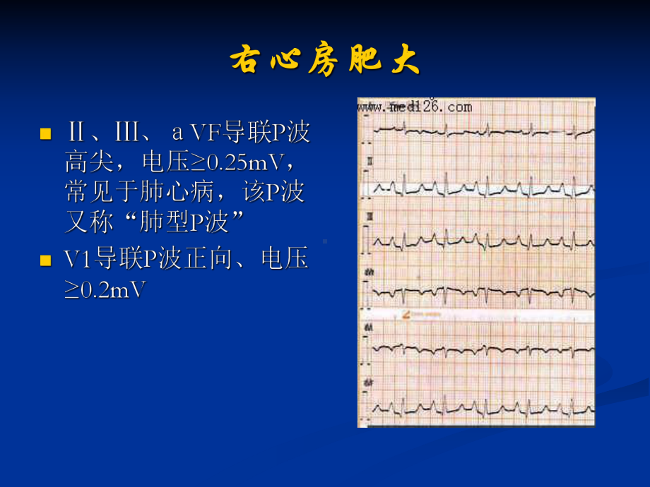 各种心电图表现 .ppt_第2页