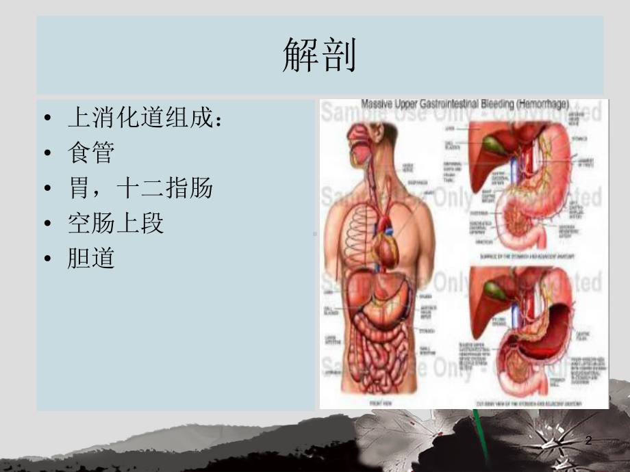 上消化道出血的抢救与护理课件.ppt_第2页