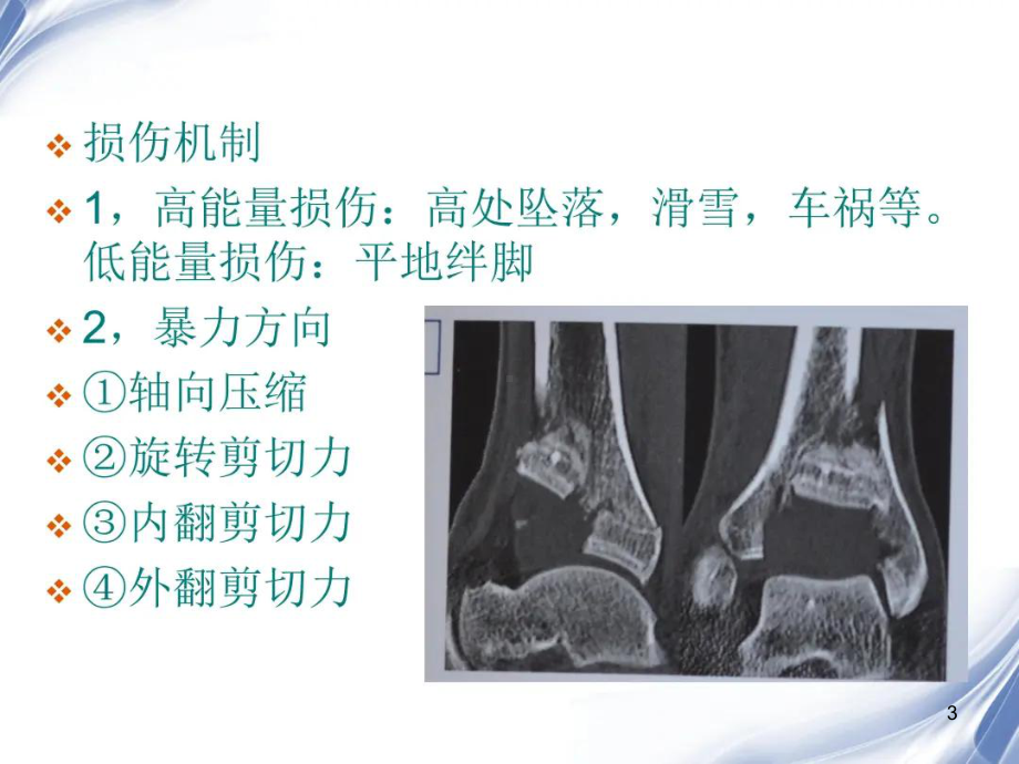 Pilon骨折教学讲解课件.ppt_第3页