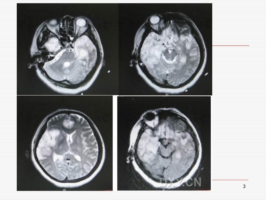 中枢神经系统感染案例分析课件.ppt_第3页