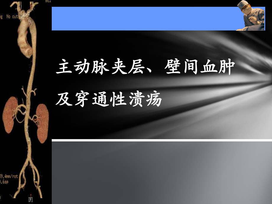 主动脉夹层、壁间血肿及穿通性溃疡课件.ppt_第1页