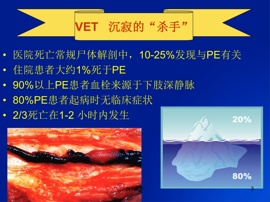 VTE预防的护理管理-课件.ppt_第3页