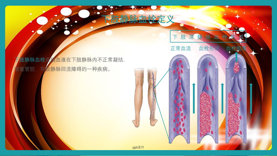 下肢静脉血栓护理查房-课件.ppt_第2页