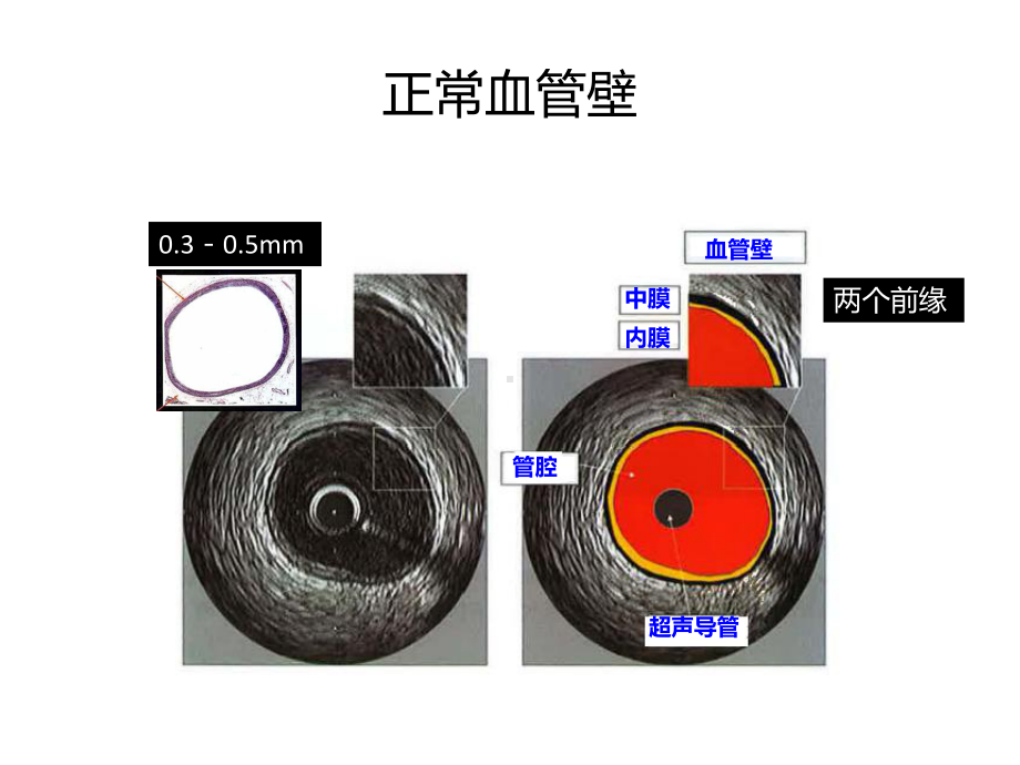 IVUS读图基本技巧-课件.ppt_第2页