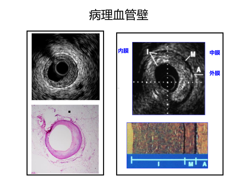 IVUS读图基本技巧-课件.ppt_第3页