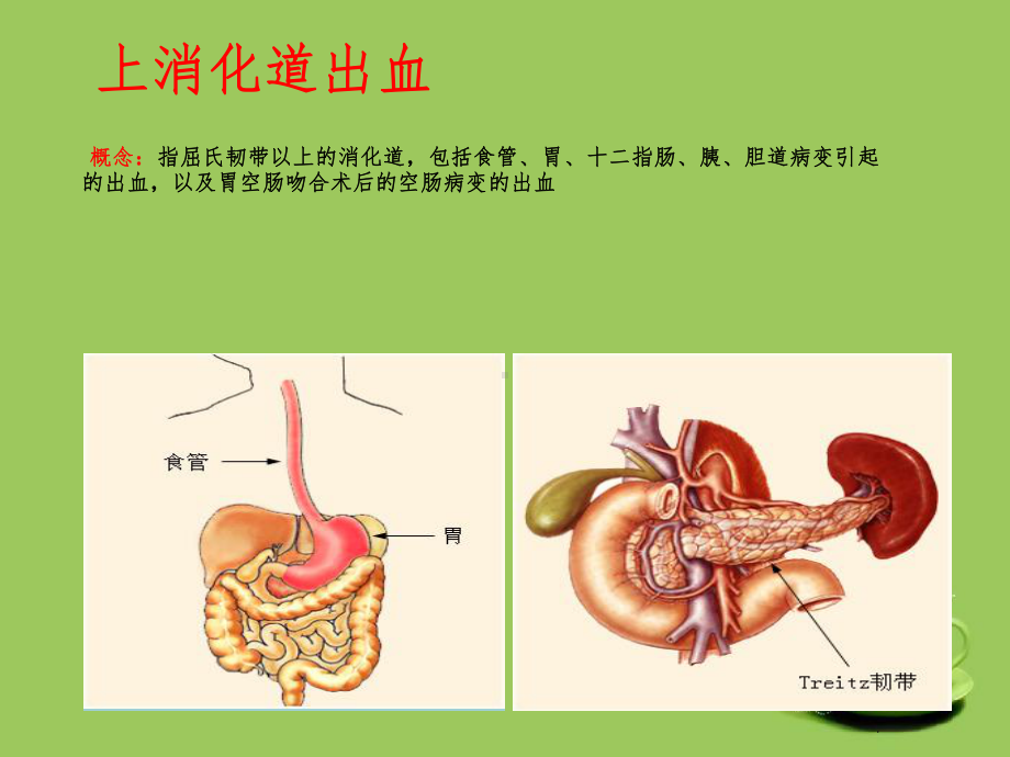 上消化道出血-护理查房课件.ppt_第2页