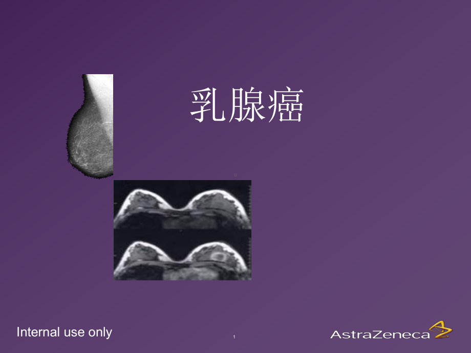 乳腺癌基础知识课件.ppt_第1页