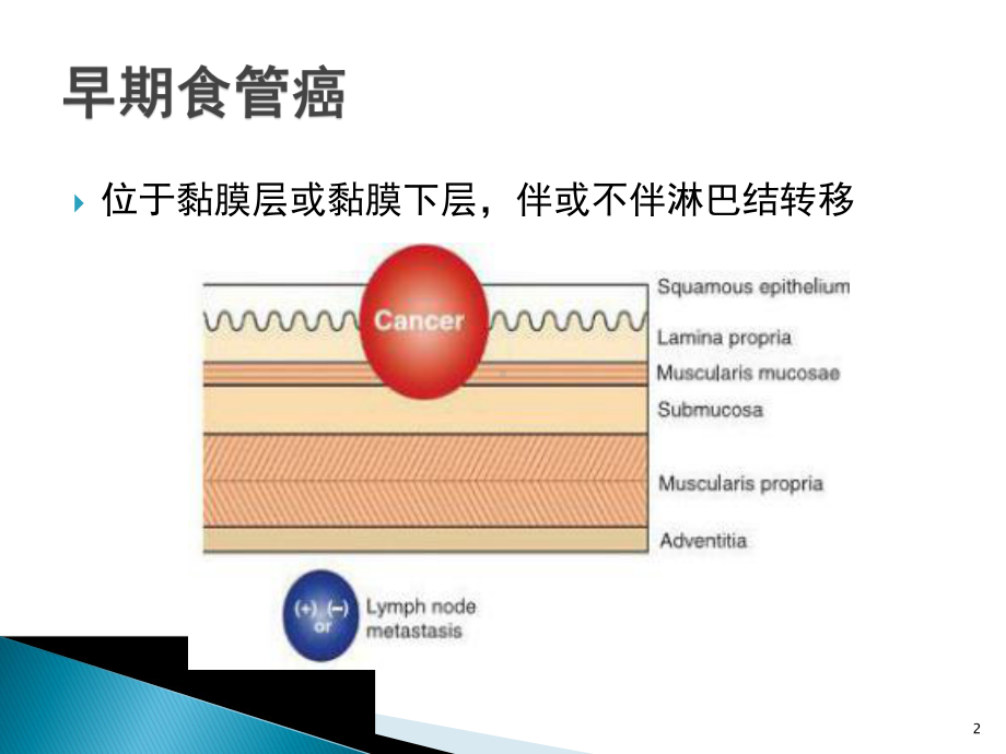 NBI+放大在食管早癌诊断中的应用进展-课课件.ppt_第2页