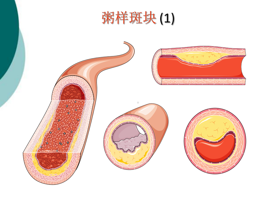 动脉粥样硬化精美图片课件.ppt_第2页