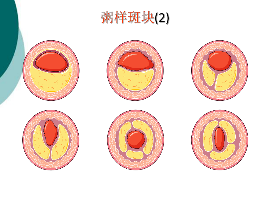 动脉粥样硬化精美图片课件.ppt_第3页