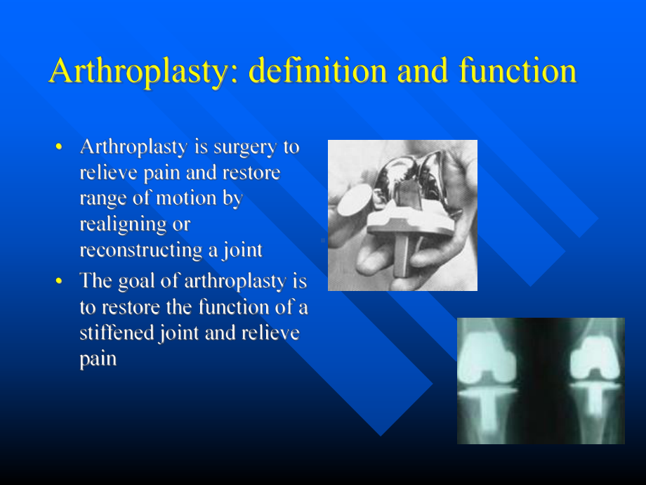 arthroplasty .ppt_第2页