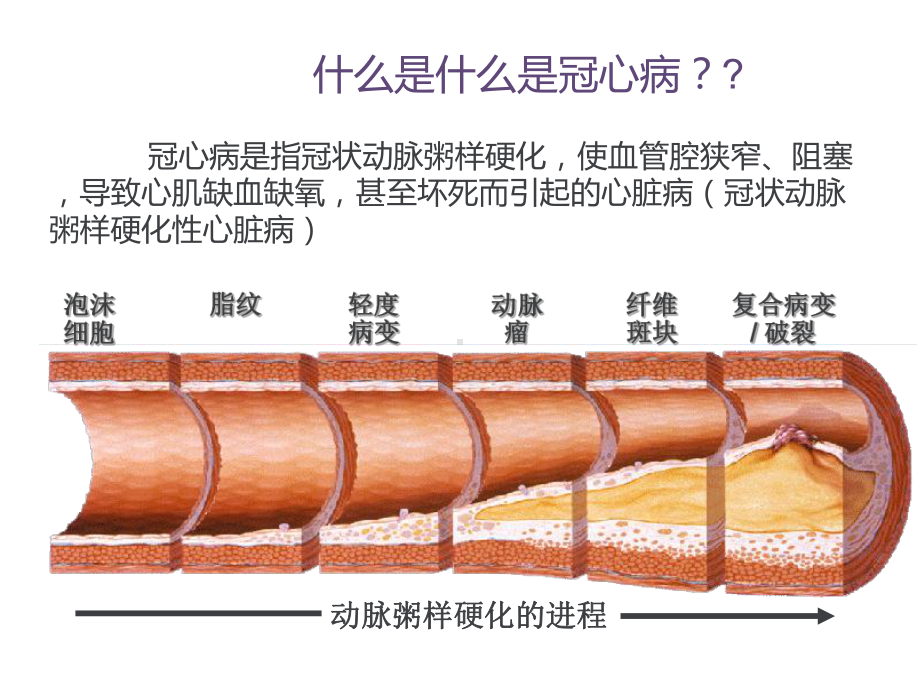 冠心病患者如何改善生活方式课件.ppt_第1页