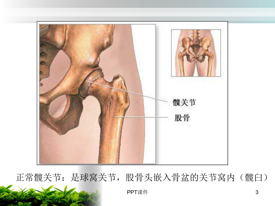 人工髋关节置换术后的护理-课件.ppt_第3页