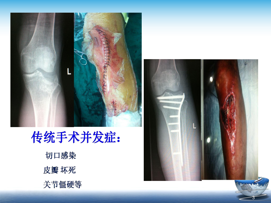 内镜及微创技术在骨科的应用课件.ppt_第3页