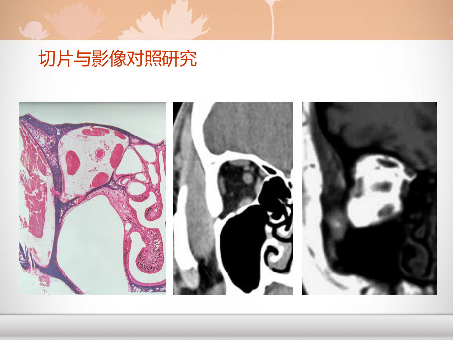 头颈部肿瘤影像诊断与鉴别-课件.ppt_第3页