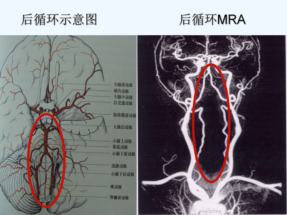 后循环缺血-课件.ppt_第3页