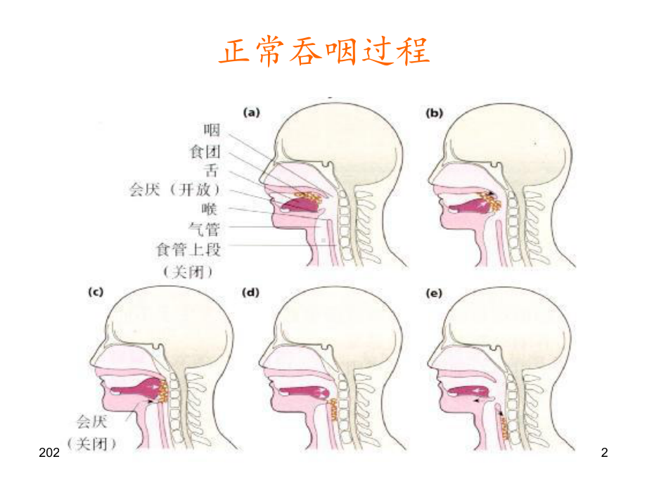 吞咽障碍护理-2-课件.ppt_第2页