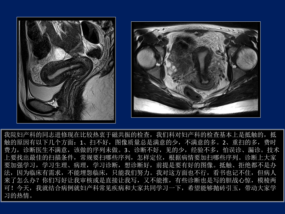 子宫MRI诊断子宫mr解剖-课件.ppt_第2页