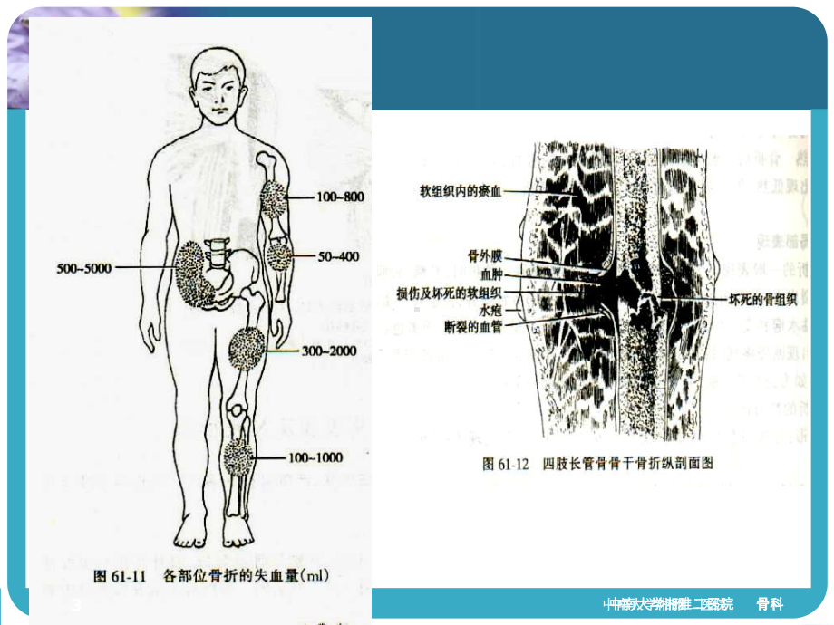 四肢骨折经典课件.ppt_第3页