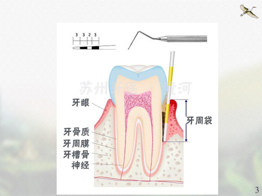 口腔内科学-牙周组织病-课件.ppt_第3页