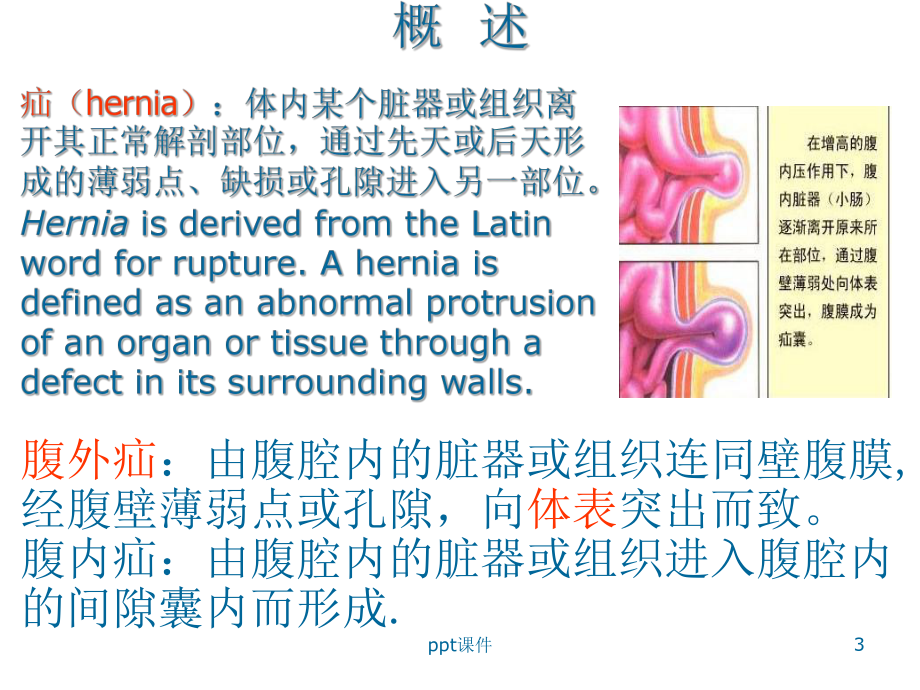 外科学腹外疝-课件.ppt_第3页