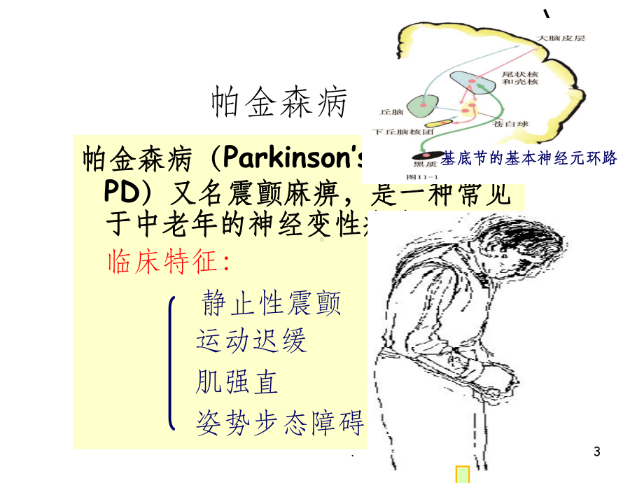 帕金森最新版完整课件.ppt_第3页