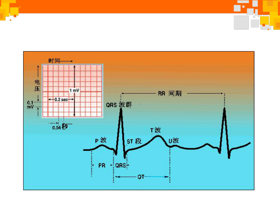 巧学常见心律失常心电图（心血管内科）-课课件.ppt_第3页