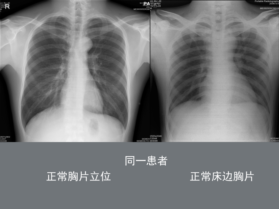 床边胸片分析-课件.ppt_第2页