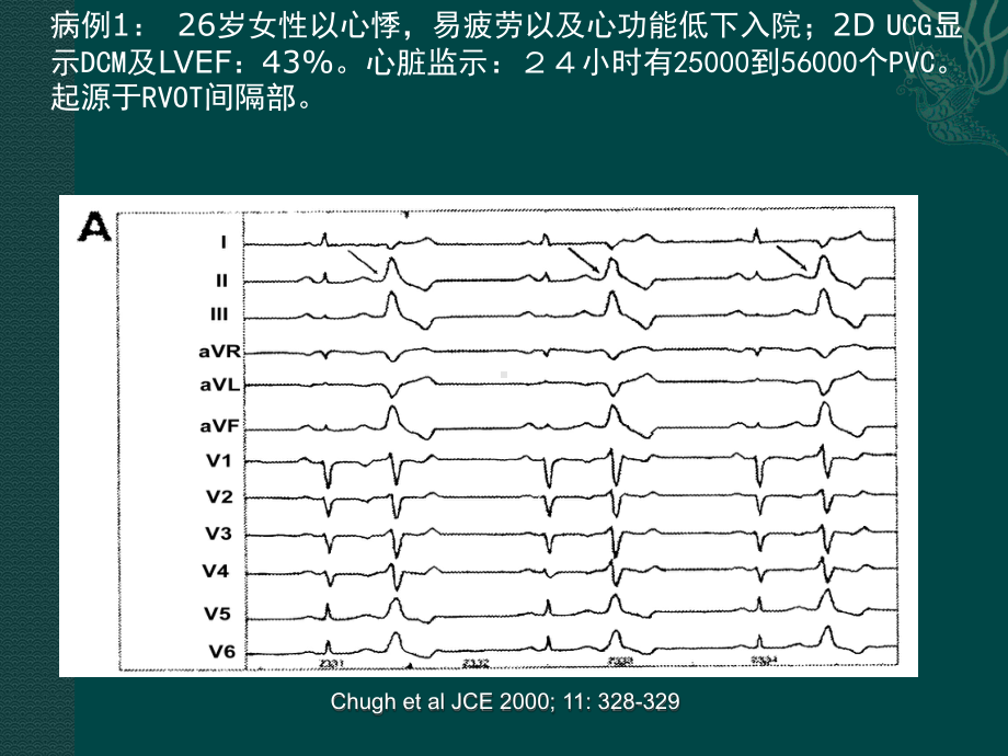 室性早搏性心肌病整理版课件.ppt_第2页