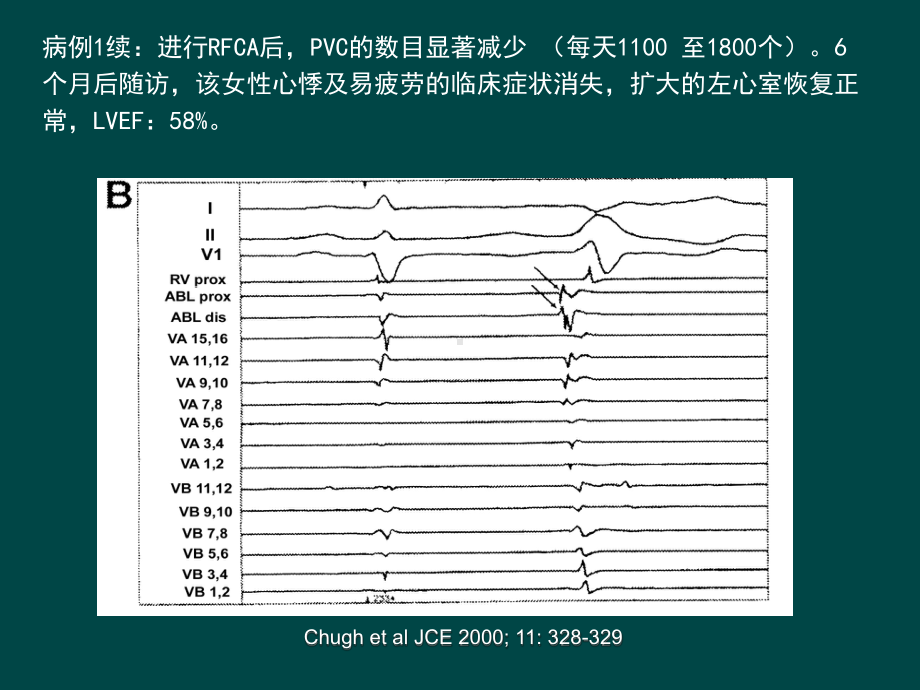 室性早搏性心肌病整理版课件.ppt_第3页