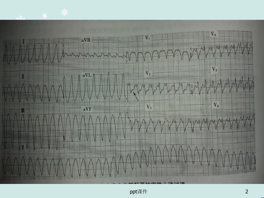 急重症心电图的快速识别及治疗-课件.ppt_第2页