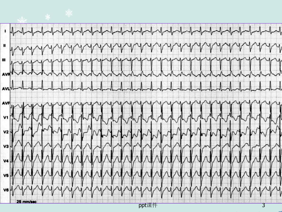 急重症心电图的快速识别及治疗-课件.ppt_第3页