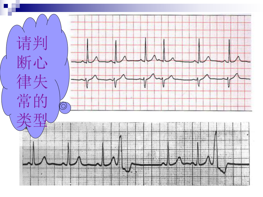 心律失常课件(同名561).ppt_第3页