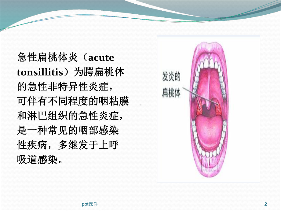 急性扁桃体炎病人的护理-课件.ppt_第2页