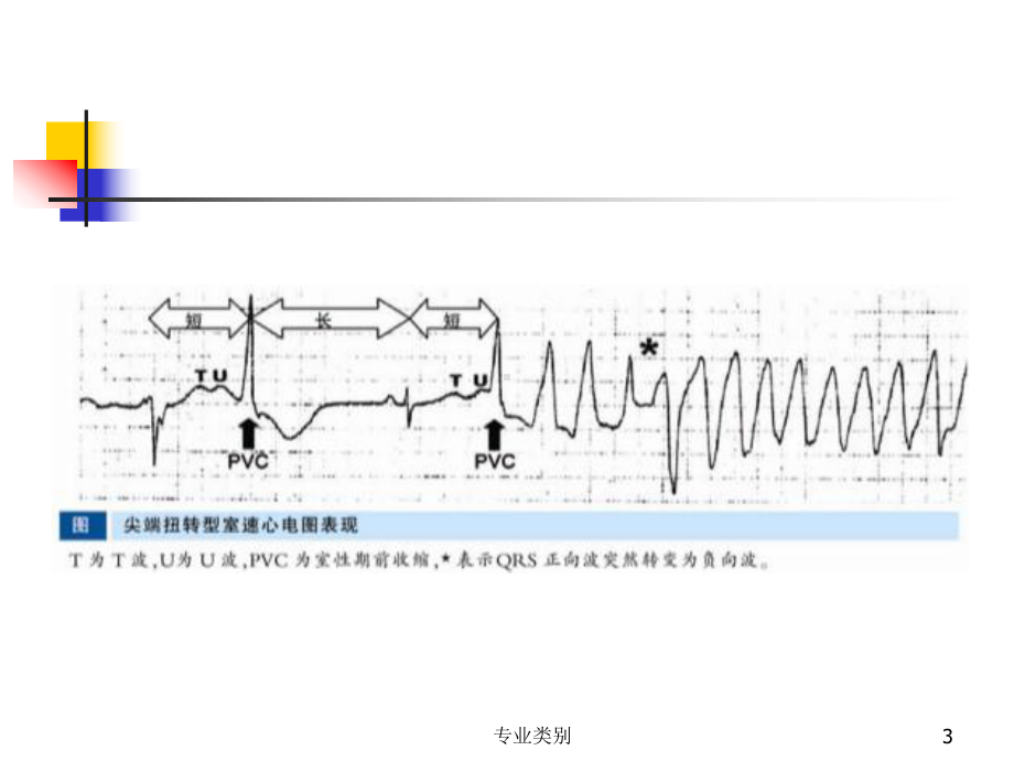 尖端扭转型室速(行业精制)课件.ppt_第3页