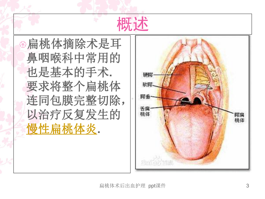 扁桃体术后出血护理-课件.ppt_第3页