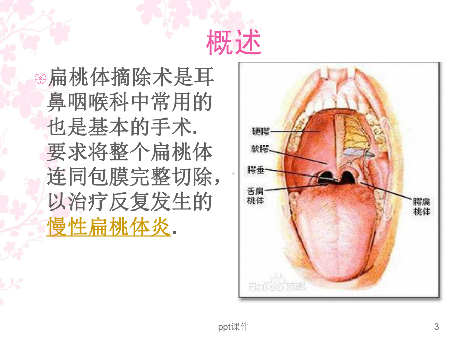 扁桃体术后出血护理-课件.ppt_第3页