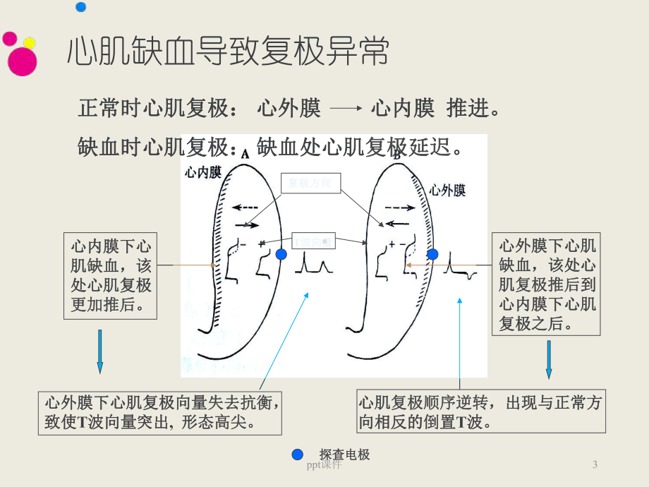 心电图-心肌缺血与ST-T改变-课件.ppt_第3页