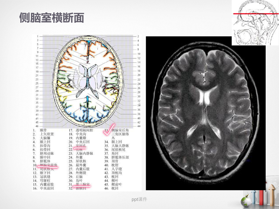 室管膜瘤-课件.ppt_第3页