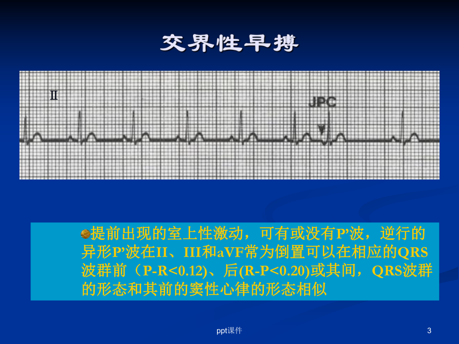 房室交界性心律失常-课件.ppt_第3页