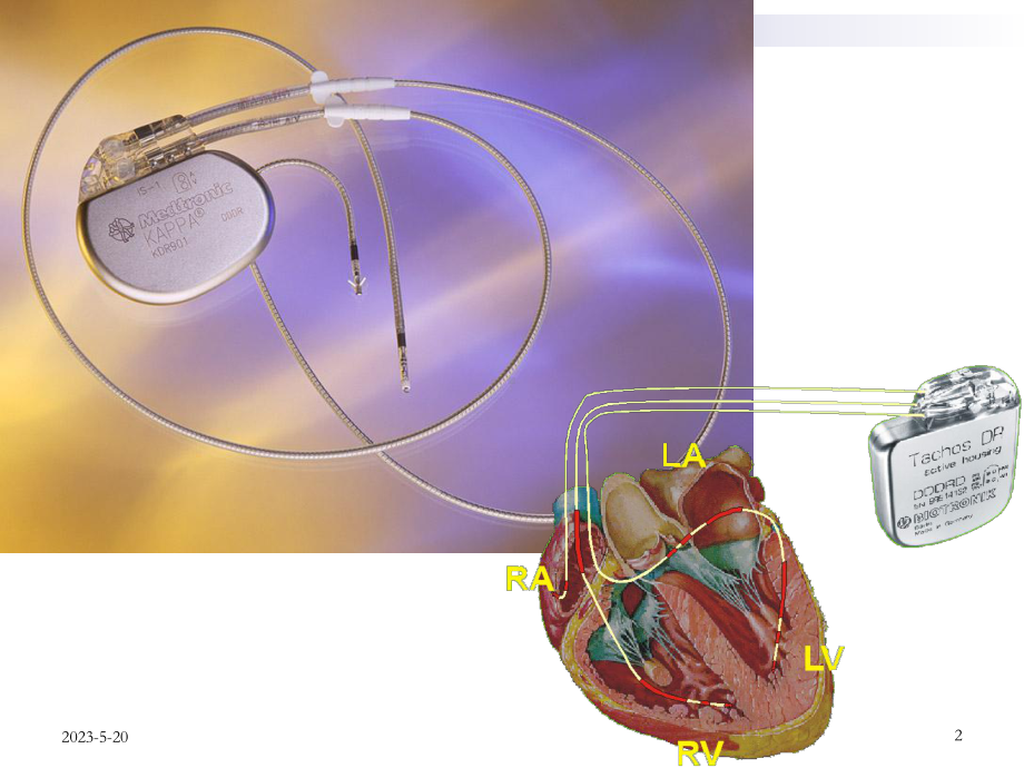心脏起搏器-课件.ppt_第2页