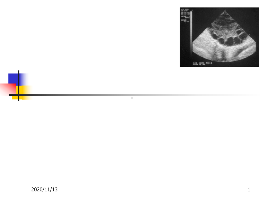 多囊卵巢综合症-课件.ppt_第1页