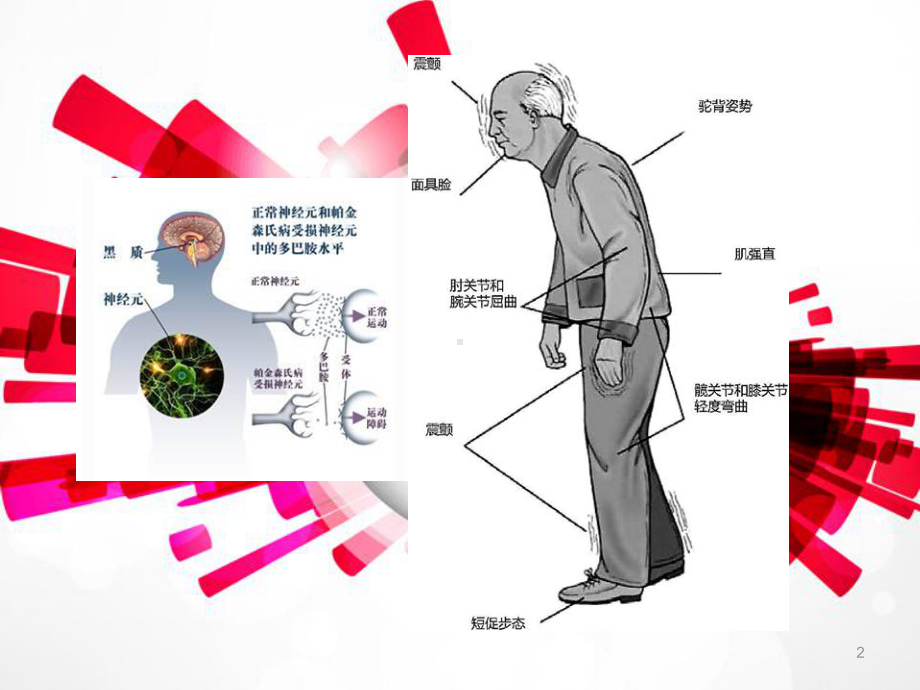 帕金森病人的家庭护理-课件.ppt_第2页